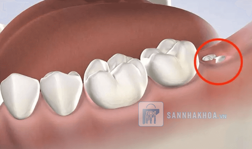 Hậu quả của việc mất răng hàm