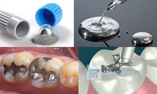 Tìm hiểu vật liệu trám Amlgam