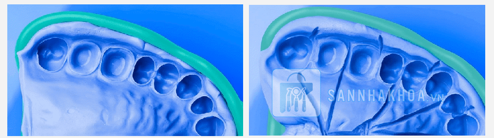 Tại sao nên sử dụng cao su đặc để lấy dấu trong nha khoa?