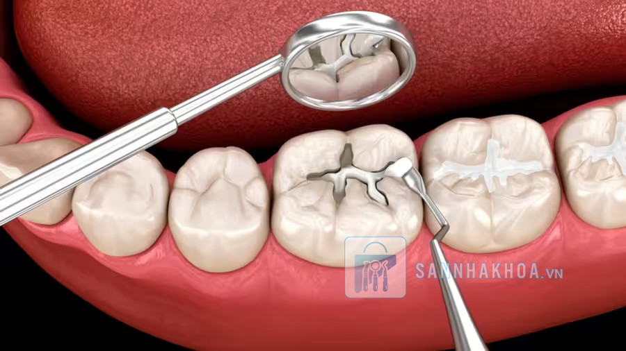 Vật liệu trám tạm dùng trong nha khoa