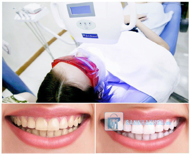 Vật liệu tẩy trắng răng