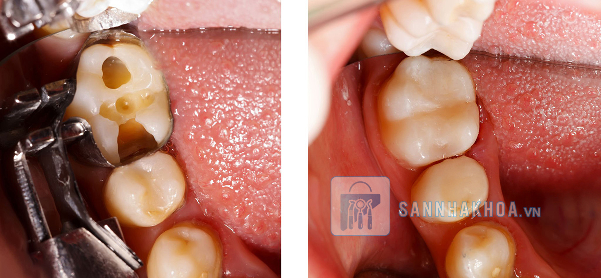 Nhóm dịch vụ phục hồi – thay thế răng mất