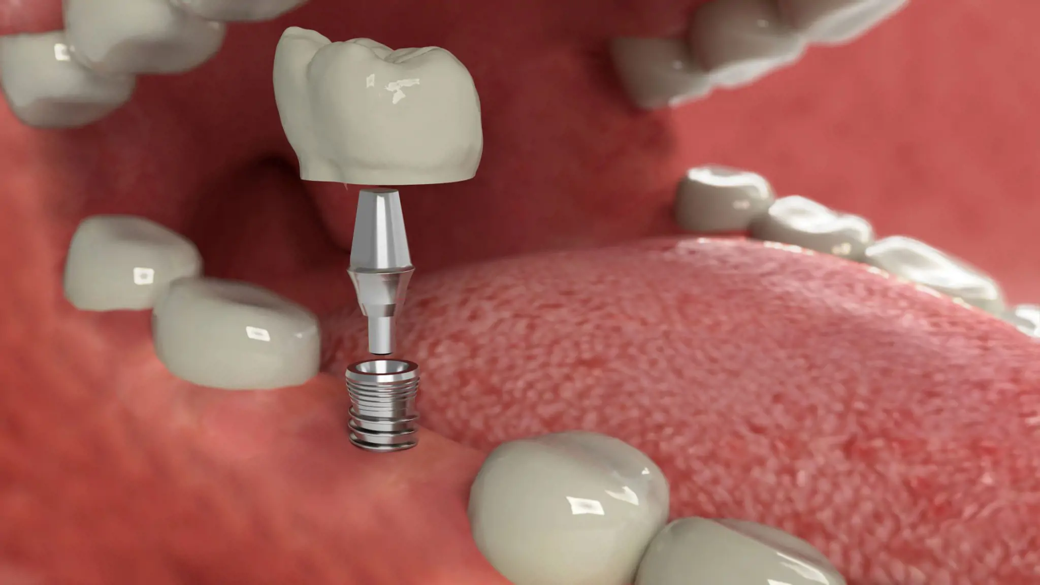 Implant nha khoa toàn diện 2025: Quy trình, chi phí & công nghệ mới nhất cho nụ cười bền vững