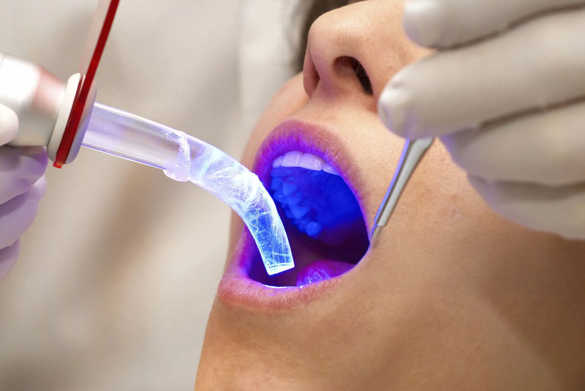 Zoom, Opalescence hay Laser Whitening – Phương pháp Nào Phù Hợp Nhất Cho Nụ Cười Của Bạn?