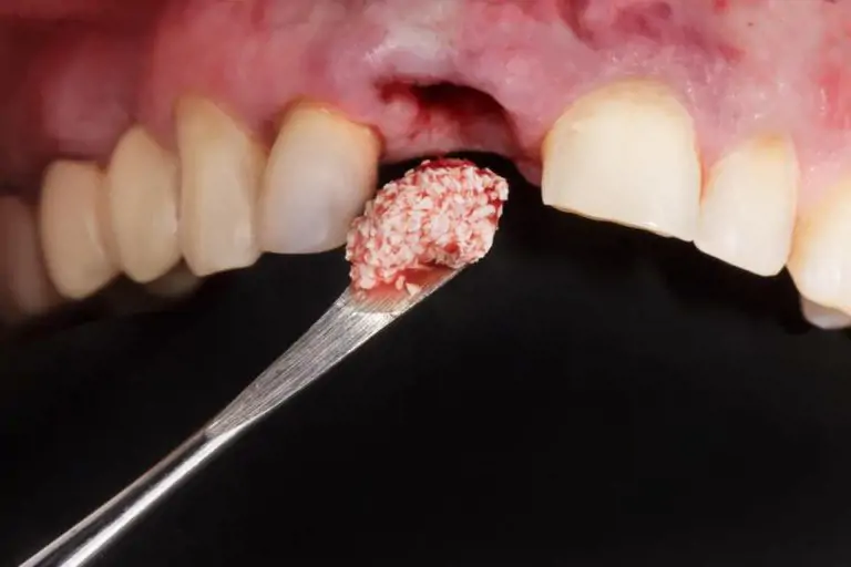 Biến chứng Implant: Nguyên nhân, Cách xử lý & Giải pháp an toàn