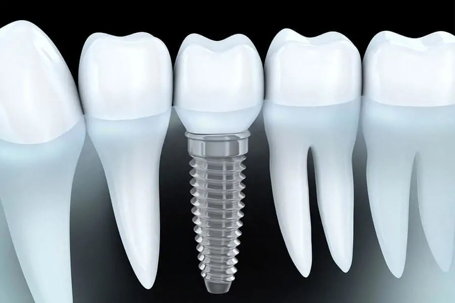 Cẩm nang Implant nha khoa từ A–Z : Quy trình, chi phí & bí quyết chọn loại Implant tốt nhất
