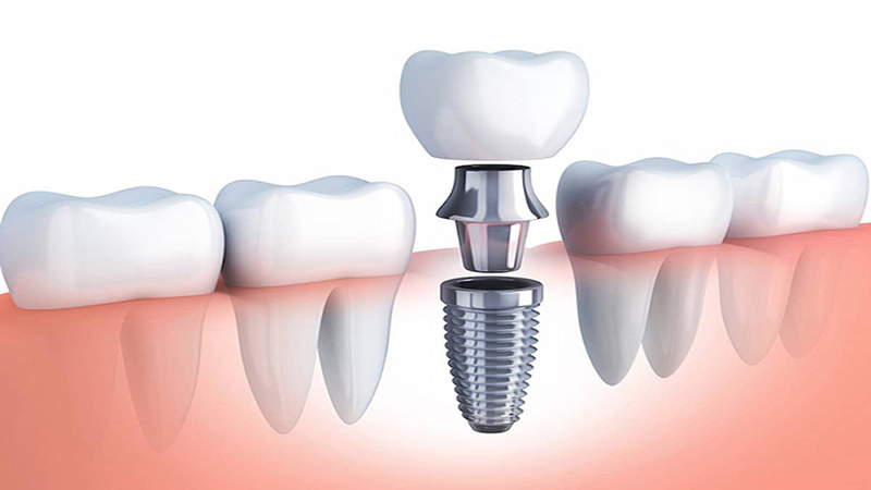 Chi phí trồng răng Implant 2025: Bảng giá mới nhất & Giải pháp tiết kiệm cho nha khoa