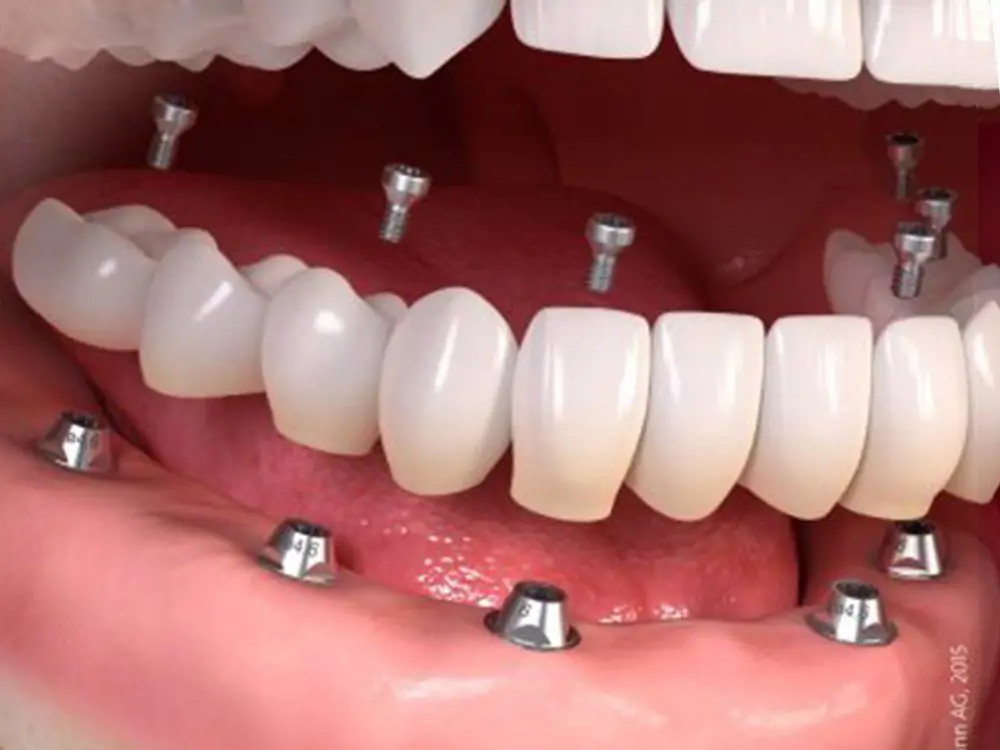 Implant kỹ thuật số: Bước đột phá với Guided Surgery – Nhanh hơn, An toàn hơn, Chính xác hơn