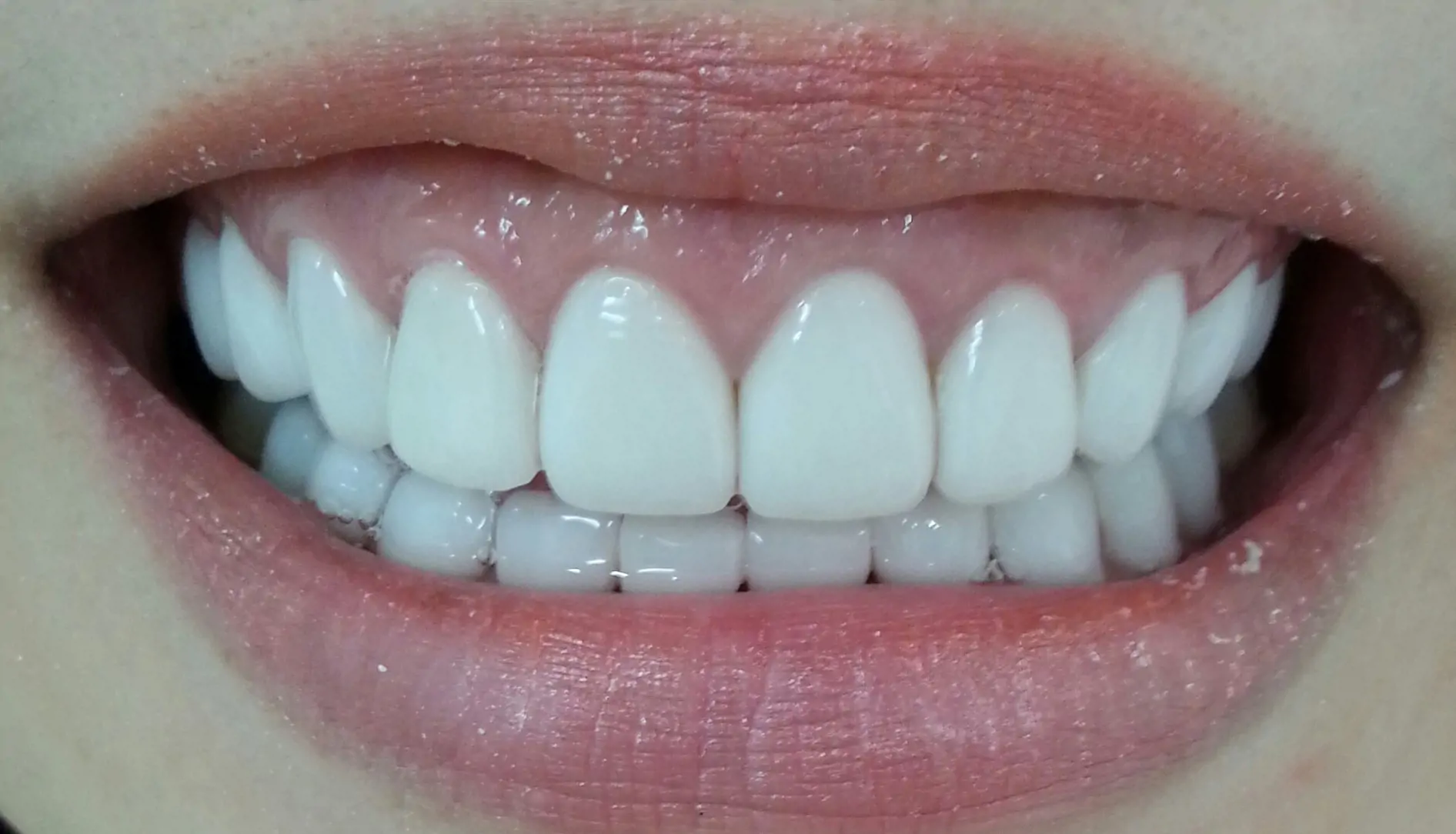 Phục hình thẩm mỹ nha khoa: Giải pháp hoàn hảo cho nụ cười tự tin & bền vững