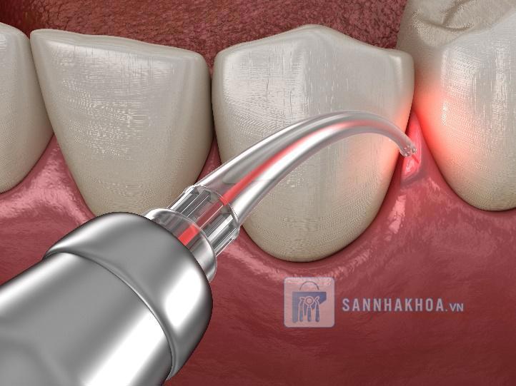 Ứng Dụng Của Máy Laser Nha Khoa Trong Điều Trị Nha Chu