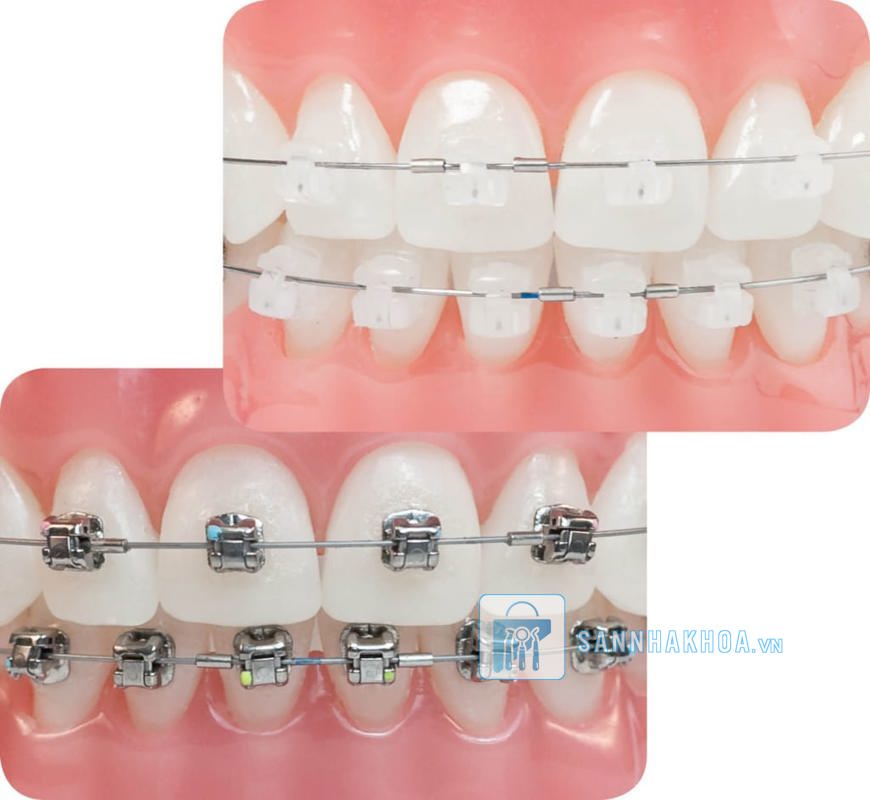 Các loại mắc loại trong chỉnh nha
