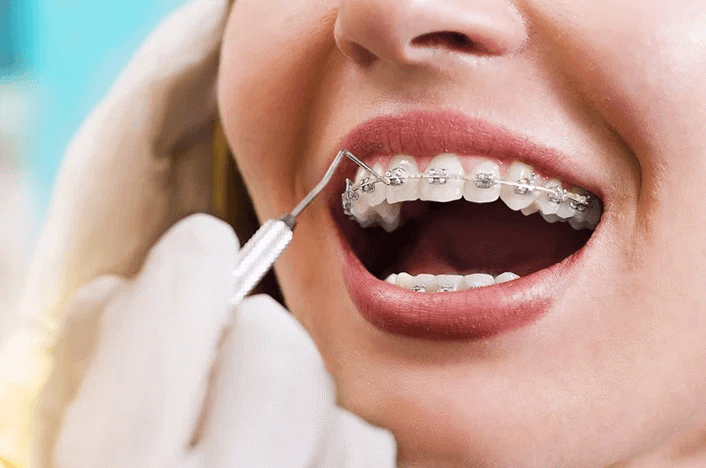 Dụng cụ chỉnh nha: Mắc cài, dây cung, kìm chỉnh nha