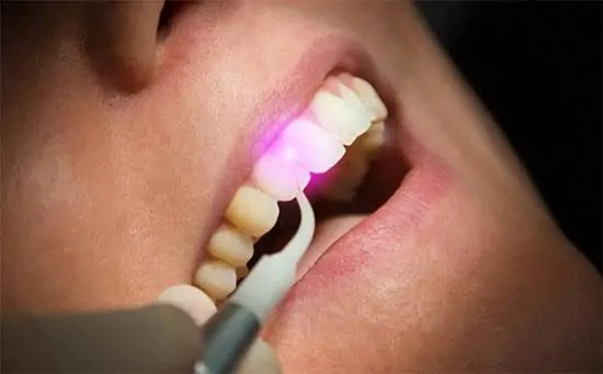 Máy Laser Nha Khoa: Ứng Dụng Trong Điều Trị Nha Chu, Thẩm Mỹ