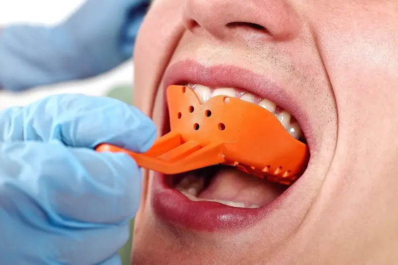 Dụng cụ lấy dấu răng thủ công và kỹ thuật số