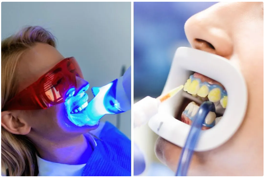 Thuốc tẩy trắng răng nha khoa: An toàn và hiệu quả
