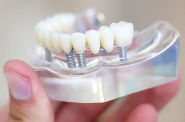 Vật liệu ghép xương nhân tạo trong cấy ghép Implant