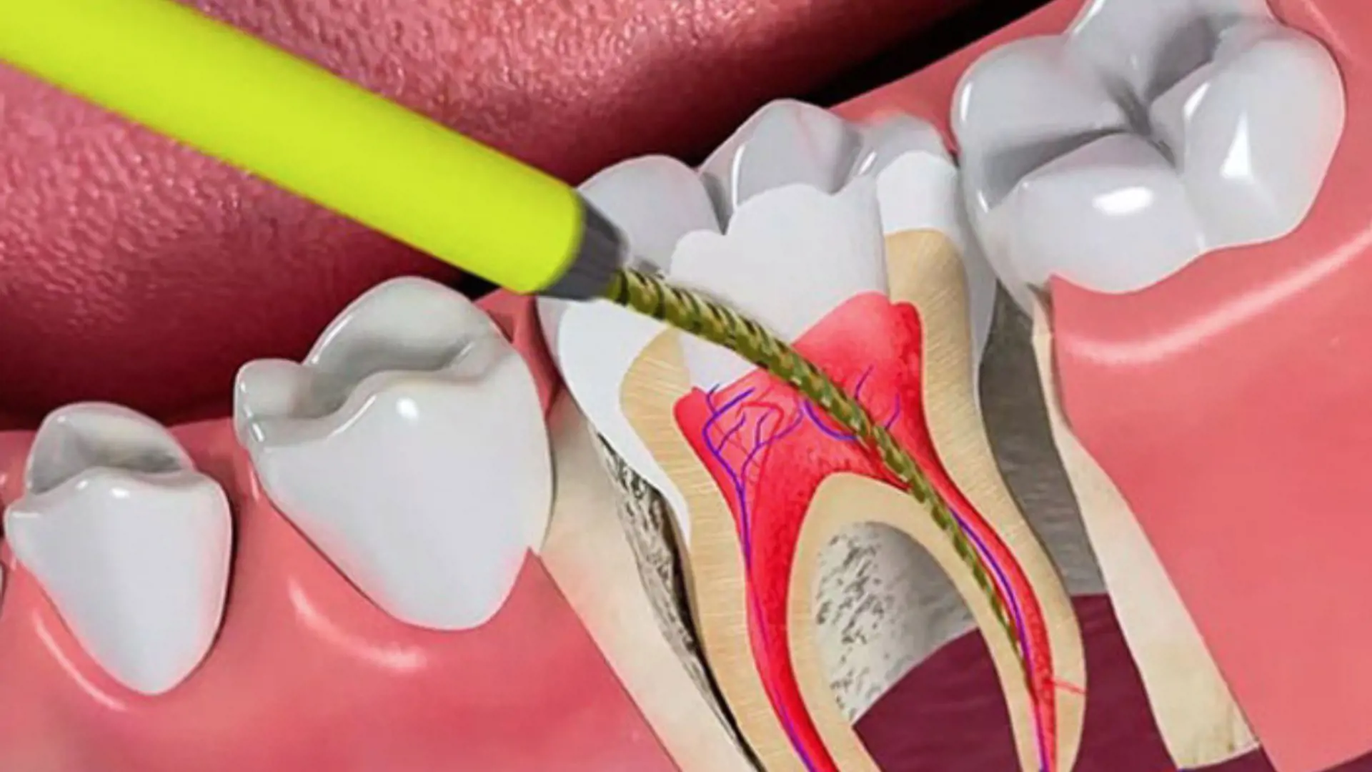 Vật liệu hàn ống tủy (Gutta Percha, Sealer): Hướng dẫn chọn mua