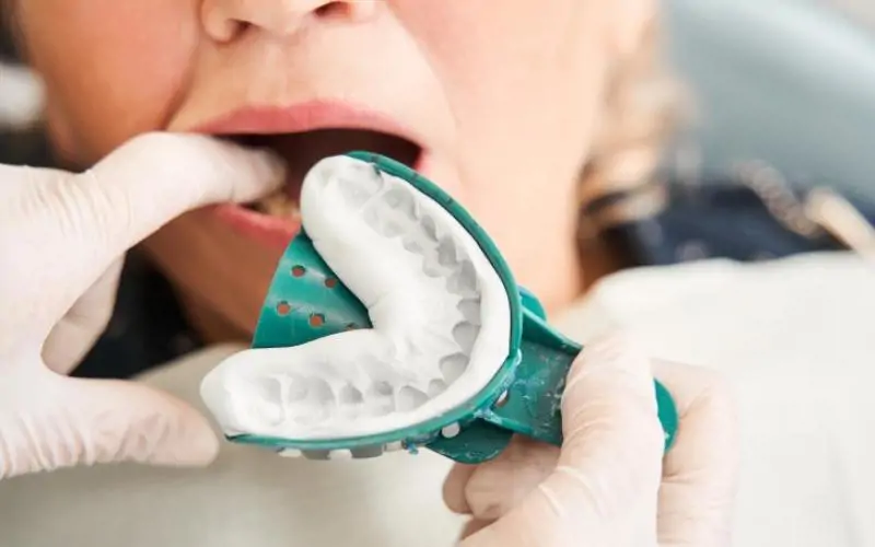 Vật liệu lấy dấu răng: Alginate vs Silicone, nên chọn loại nào?