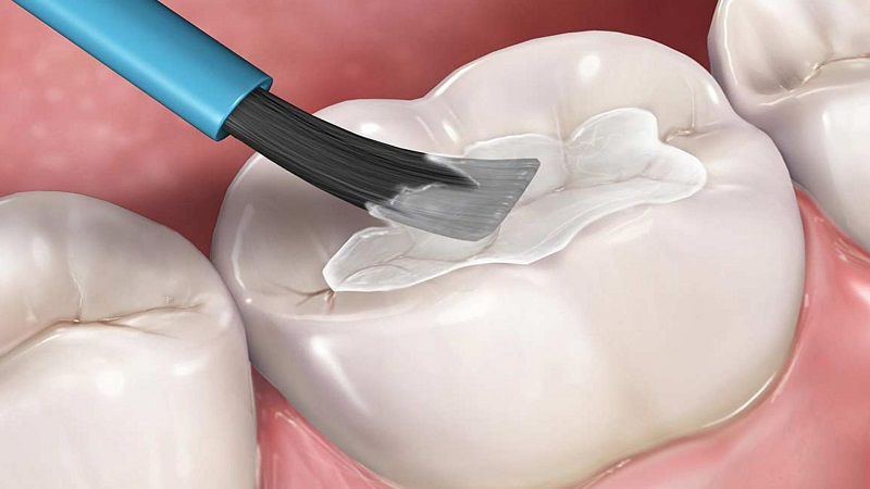 Xi măng nha khoa (GIC, Resin Cement): Phân biệt và cách dùng
