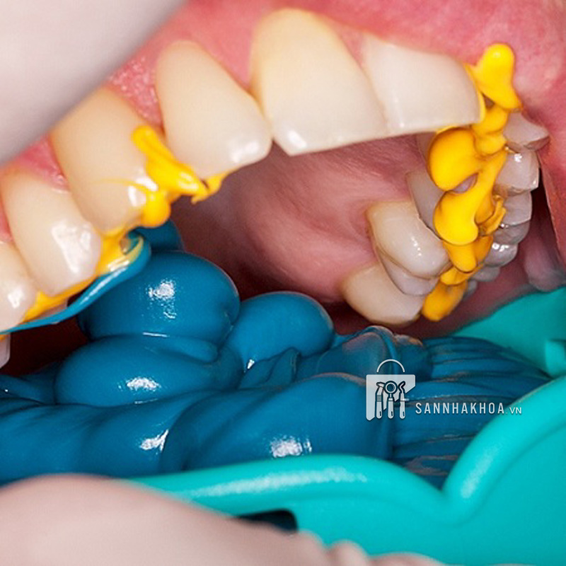 cao su lấy dấu cắn - ảnh sản phẩm thực tế