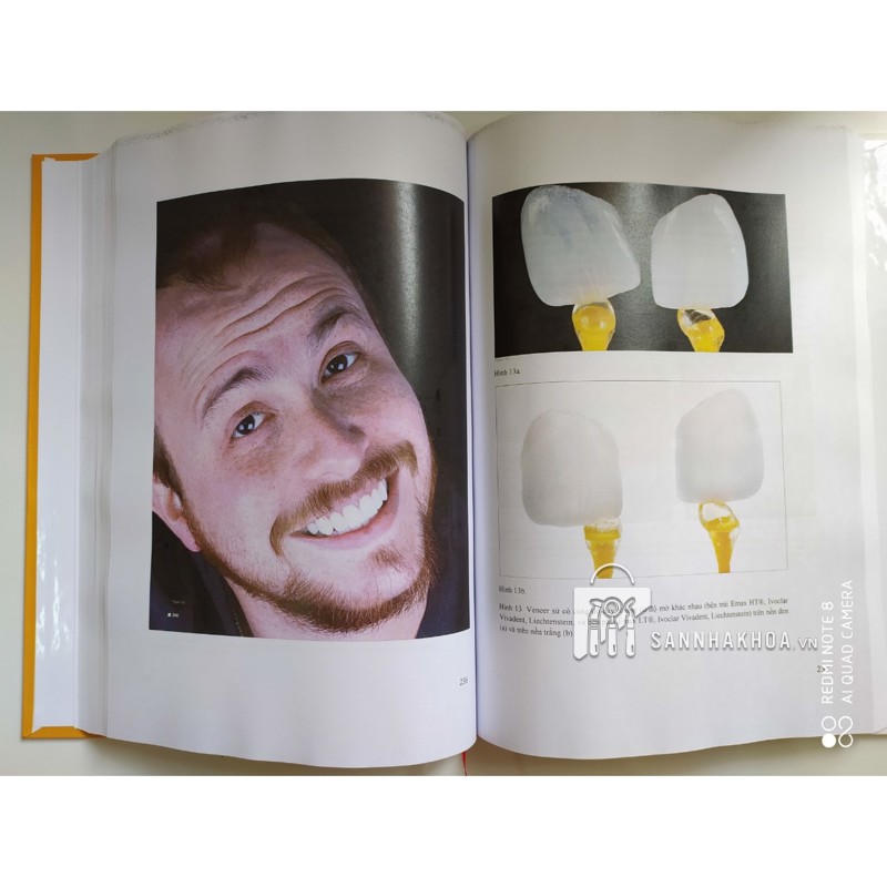 Veneer - Nguyên tắc kế hoạch và kỹ thuật - ảnh sản phẩm thực tế