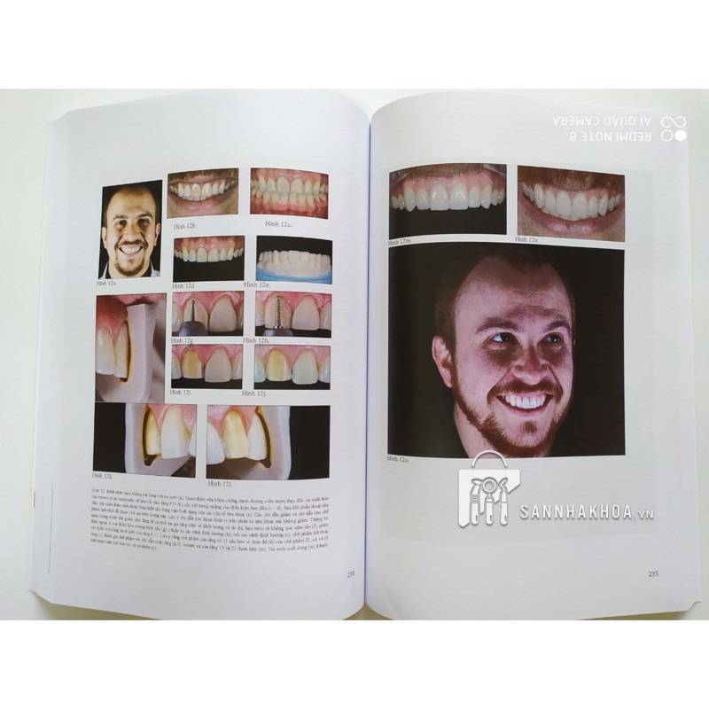 Veneer - Nguyên tắc kế hoạch và kỹ thuật - ảnh sản phẩm thực tế