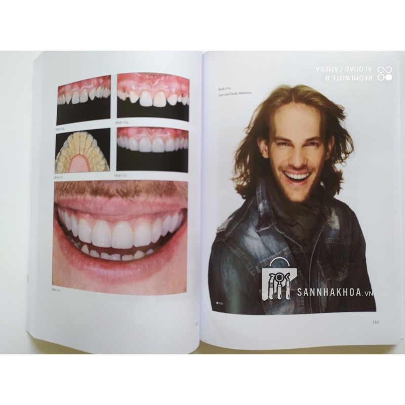 Veneer - Nguyên tắc kế hoạch và kỹ thuật - ảnh sản phẩm thực tế