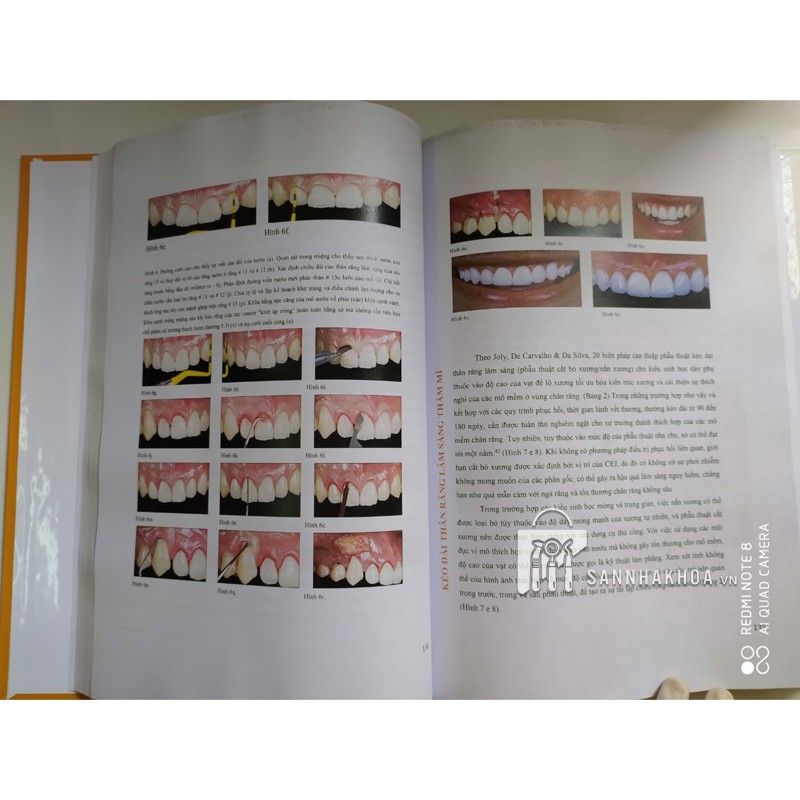 Veneer - Nguyên tắc kế hoạch và kỹ thuật - ảnh sản phẩm thực tế