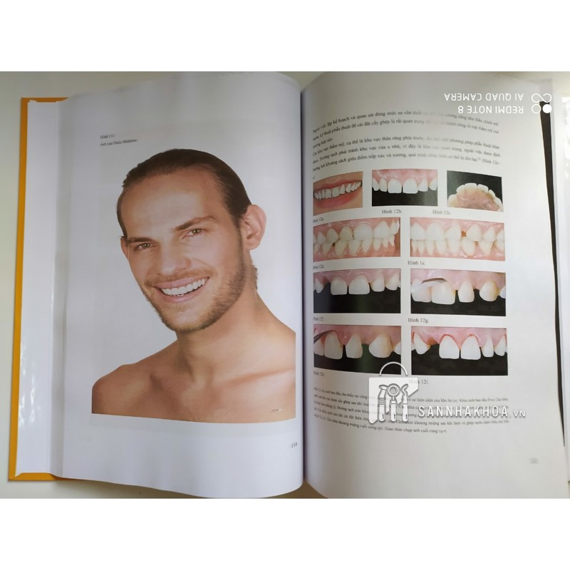 Veneer - Nguyên tắc kế hoạch và kỹ thuật - ảnh sản phẩm thực tế