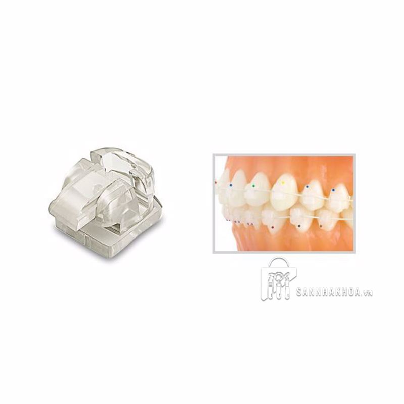 mắc cài chỉnh nha tự - ảnh sản phẩm thực tế