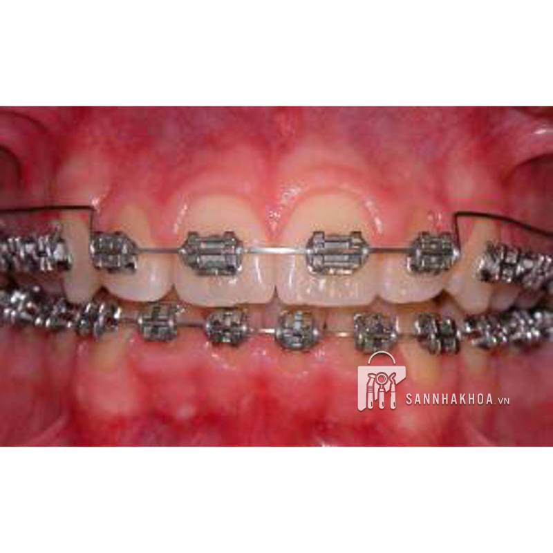 sò đánh bóng nupro dentsply sirona - ảnh sản phẩm thực tế sò đánh bóng nupro dentsply sirona - ảnh sản phẩm thực tế