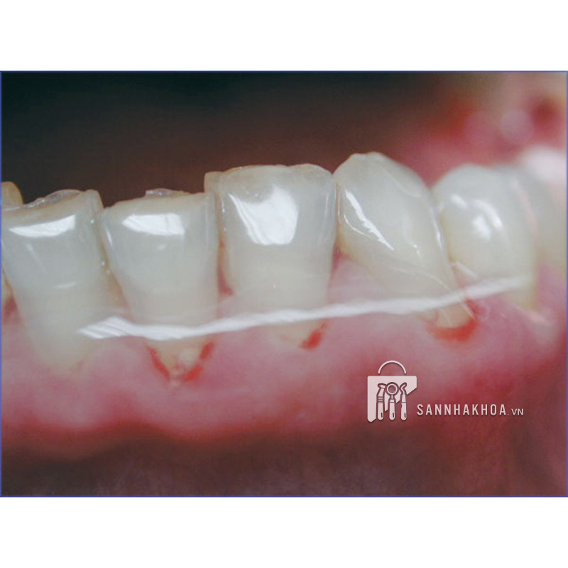 Gel Trị Lở Miệng Tinh Chất Dạng Micro Miradont Hager Werken - ảnh sản phẩm thực tế