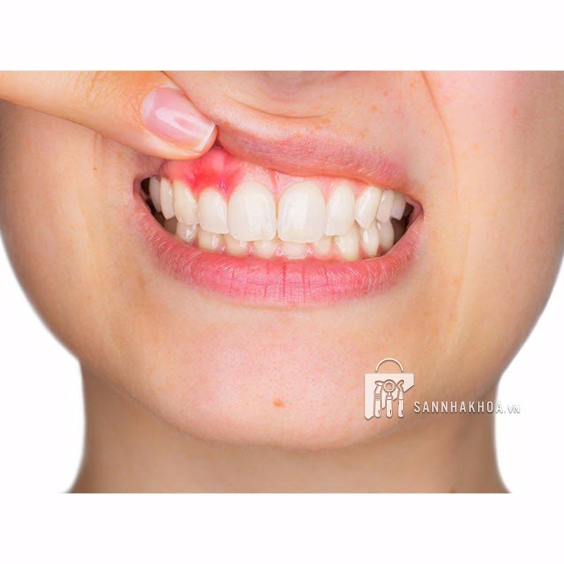 gel điều trị nha chu - ảnh sản phẩm thực tế