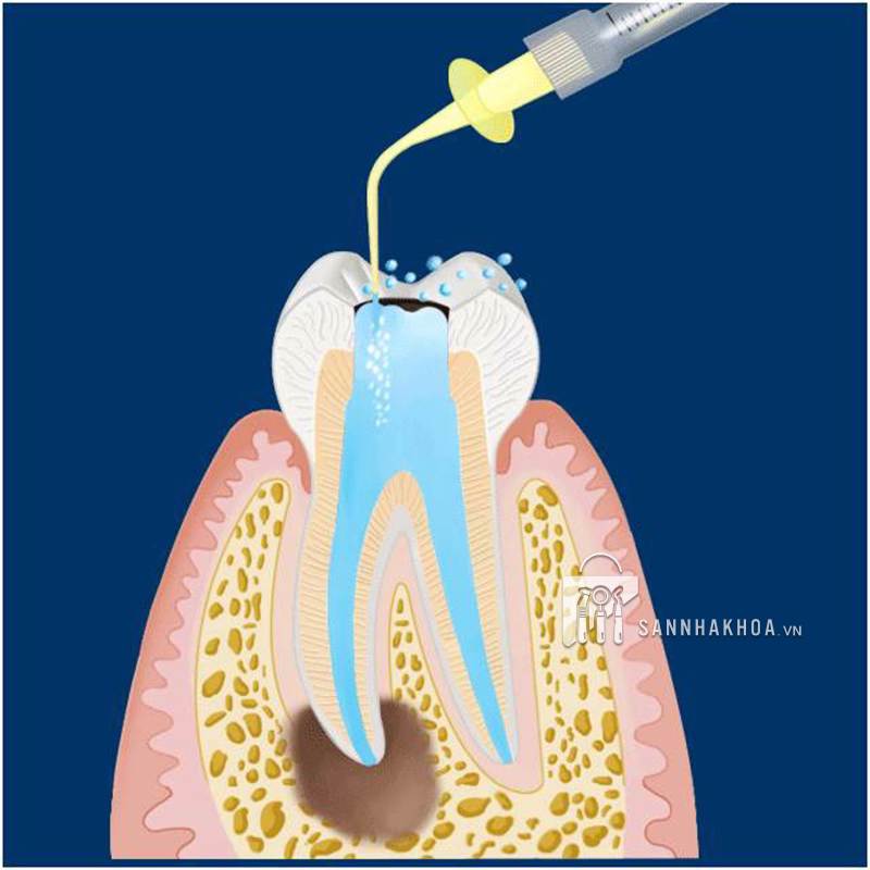 Ông bơm rữa nội nha Irrigating Syringe YDM 3ml - ảnh sản phẩm thực tế