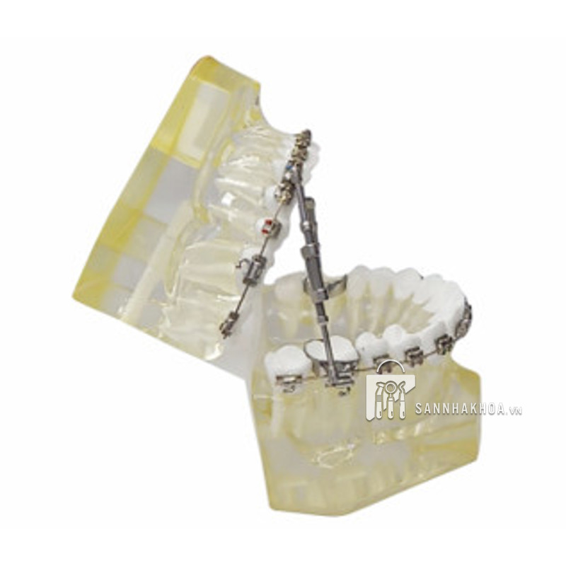 Giá khớp chỉnh nha có mắc cài và khí cụ TWINFORCE