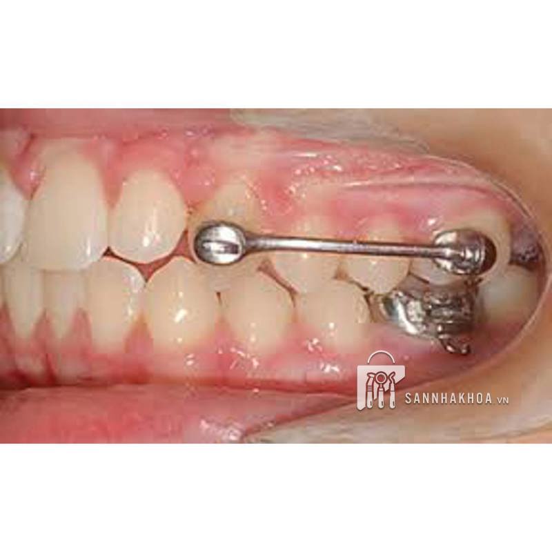 Khí cụ điều trị sai khớp cắn loại 2 CARRIERE MOTION kim loại trái/phải (cỡ: 16mm – 27mm) - ảnh sản phẩm thực tế