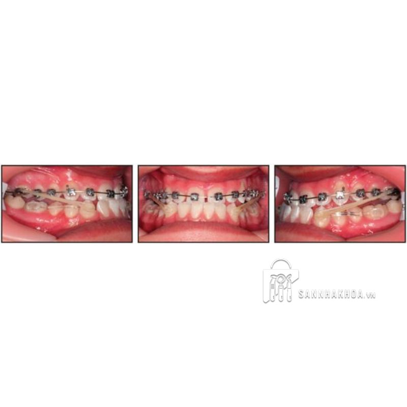 Khí cụ điều trị sai khớp cắn loại II CARRIERE MOTION trong suốt trái/phải (cỡ: 16mm – 27mm) - ảnh sản phẩm thực tế