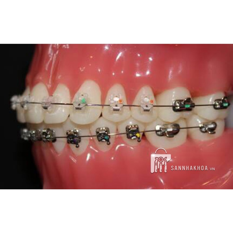 mắc cài răng 7 - ảnh sản phẩm thực tế