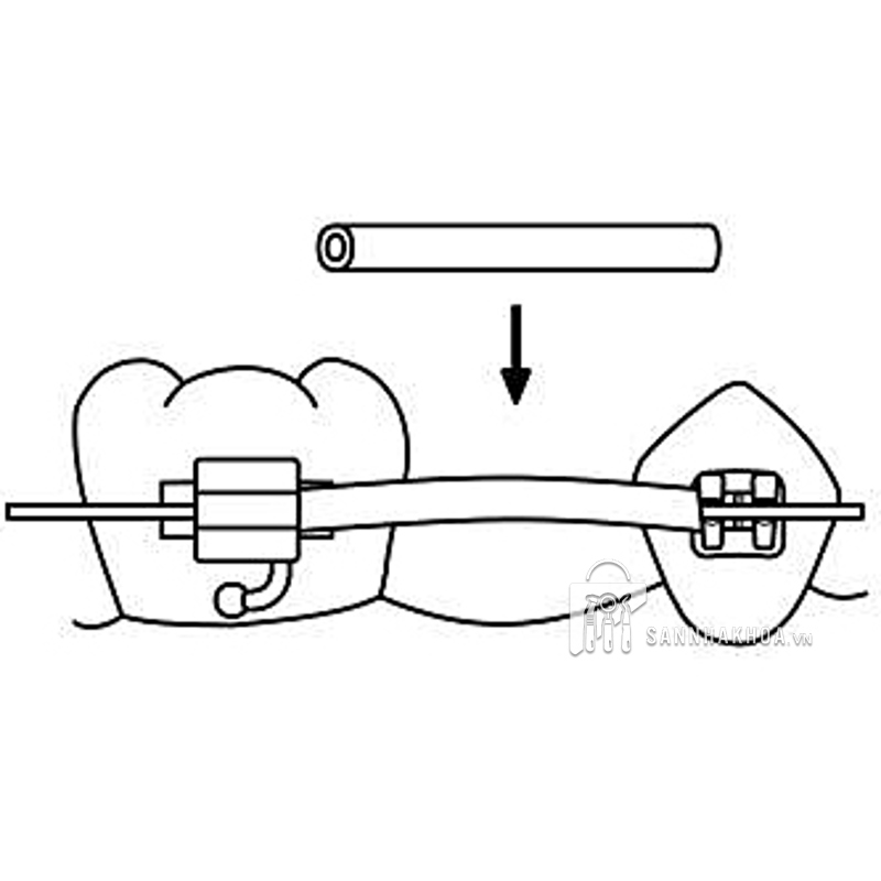 Ống luồn dây cung bảo vệ Nướu/Lợi.046 TISSUE GUARD màu trong/xám - ảnh sản phẩm thực tế