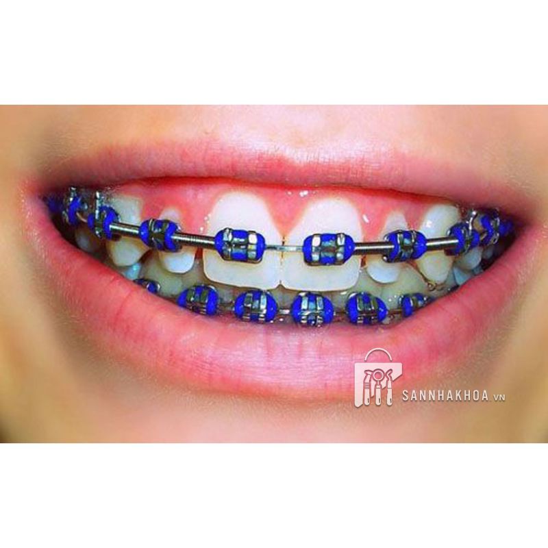 Mua Thun Buộc Mắc Cài (Trong/Xám) Elastomeric Ligatures ️ Giá Rẻ Nhất