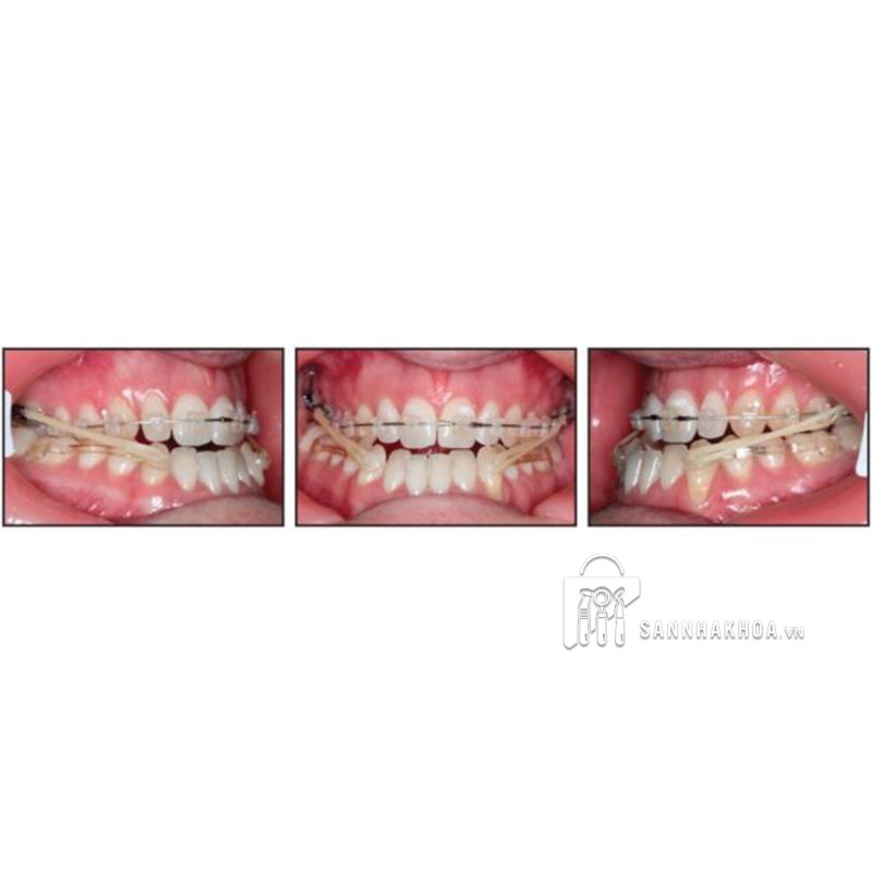 thun liên hàm 1/4 - ảnh sản phẩm thực tế