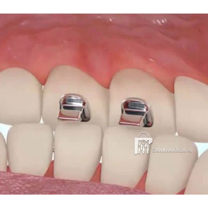 Nút Chặn Khớp Bite Turbos