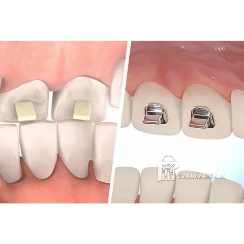 Nút dán nâng khớp cắn Eksen