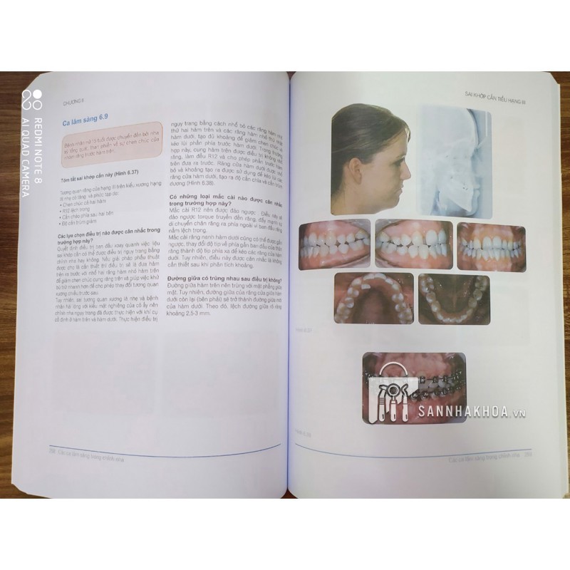 chỉnh nha lâm sàn - ảnh sản phẩm thực tế