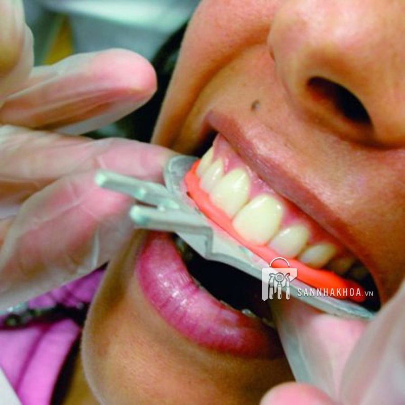 cao su lấy dấu khớp cắn (smartsil bite) - ảnh sản phẩm thực tế