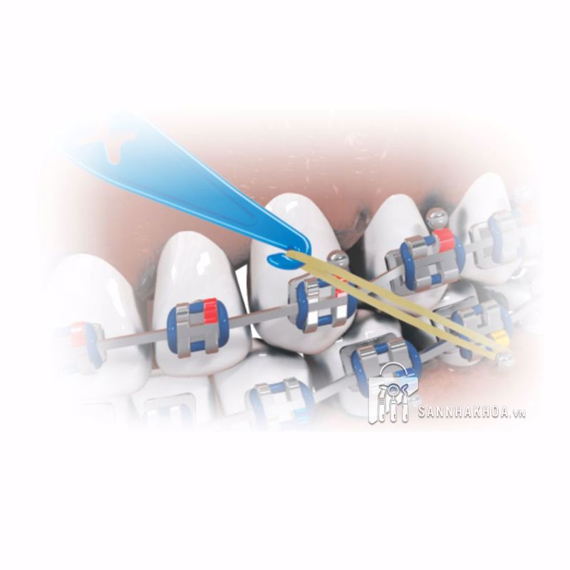 thun kéo liên hàm - ảnh sản phẩm thực tế