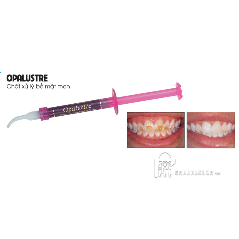chất xử lý bề mặt men răng opalustre - ảnh sản phẩm thực tế