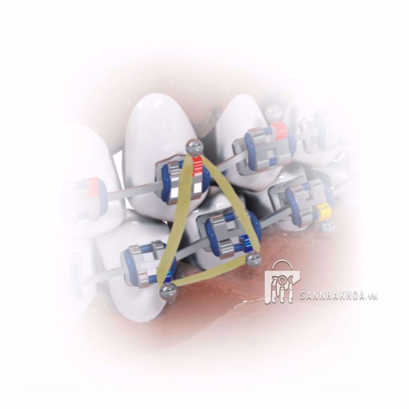 thun kéo liên hàm chỉnh nha - ảnh sản phẩm thực tế thun kéo liên hàm chỉnh nha - ảnh sản phẩm thực tế