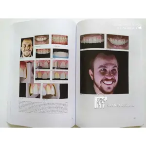 Veneer - Nguyên tắc kế hoạch và kỹ thuật - ảnh sản phẩm thực tế