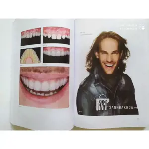 Veneer - Nguyên tắc kế hoạch và kỹ thuật - ảnh sản phẩm thực tế